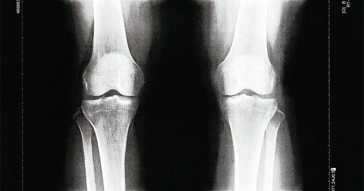 A blood test may show signs ofOsteoarthritis 8 years early