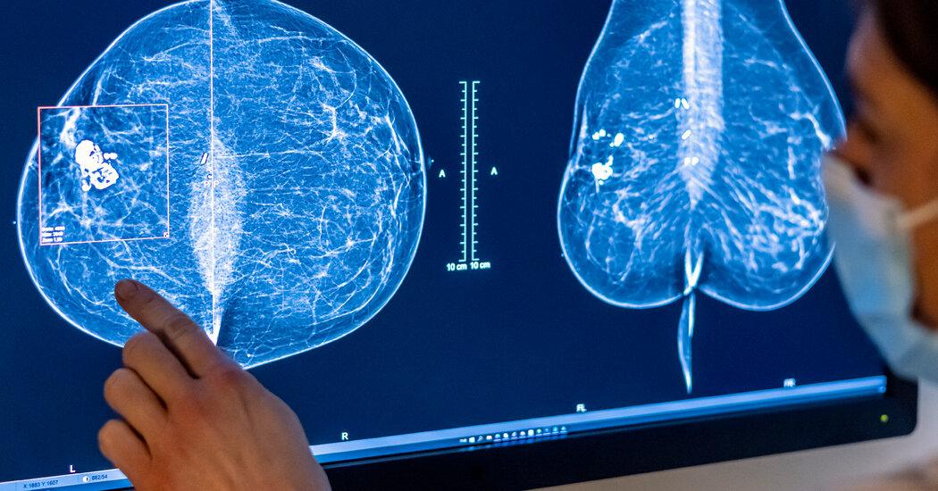 Breast Cancer Screening at 40 is recommended by an expert panel