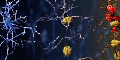 Brain autopsies show a potential new cause of Alzheimer's disease
